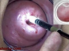 Endoscope With Camera Is Inserted Into The Cervix To See Inside